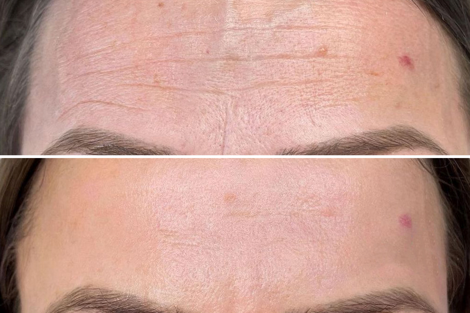 Het effect van microneedling op celvernieuwing
